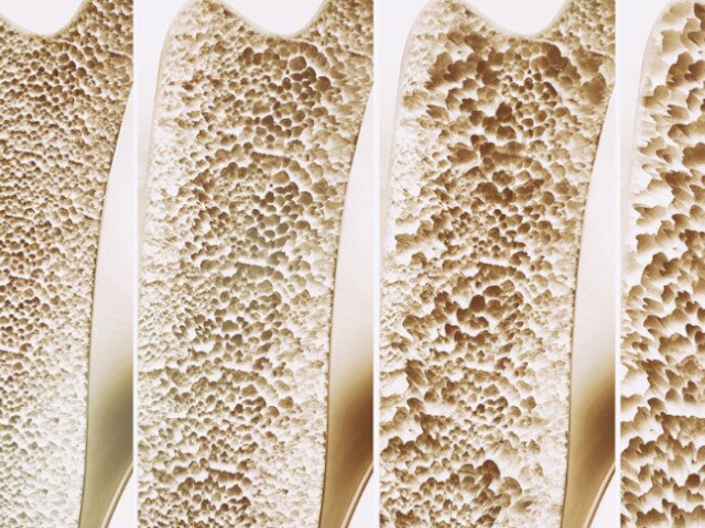 osteoporosi osteoporosi
