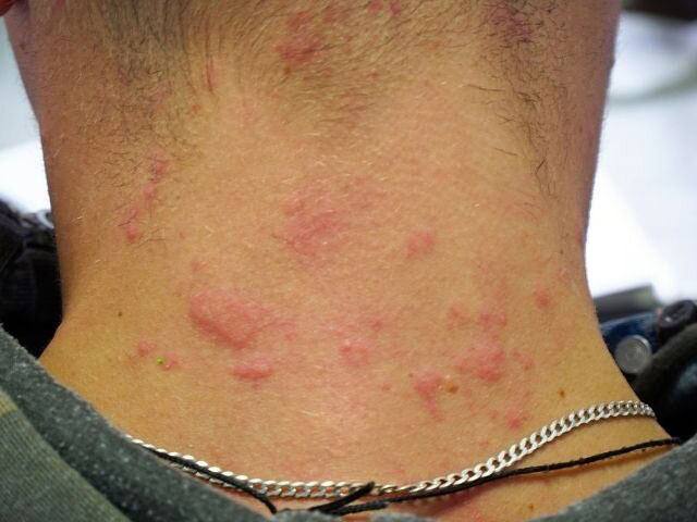 sintomi allergia al nichel